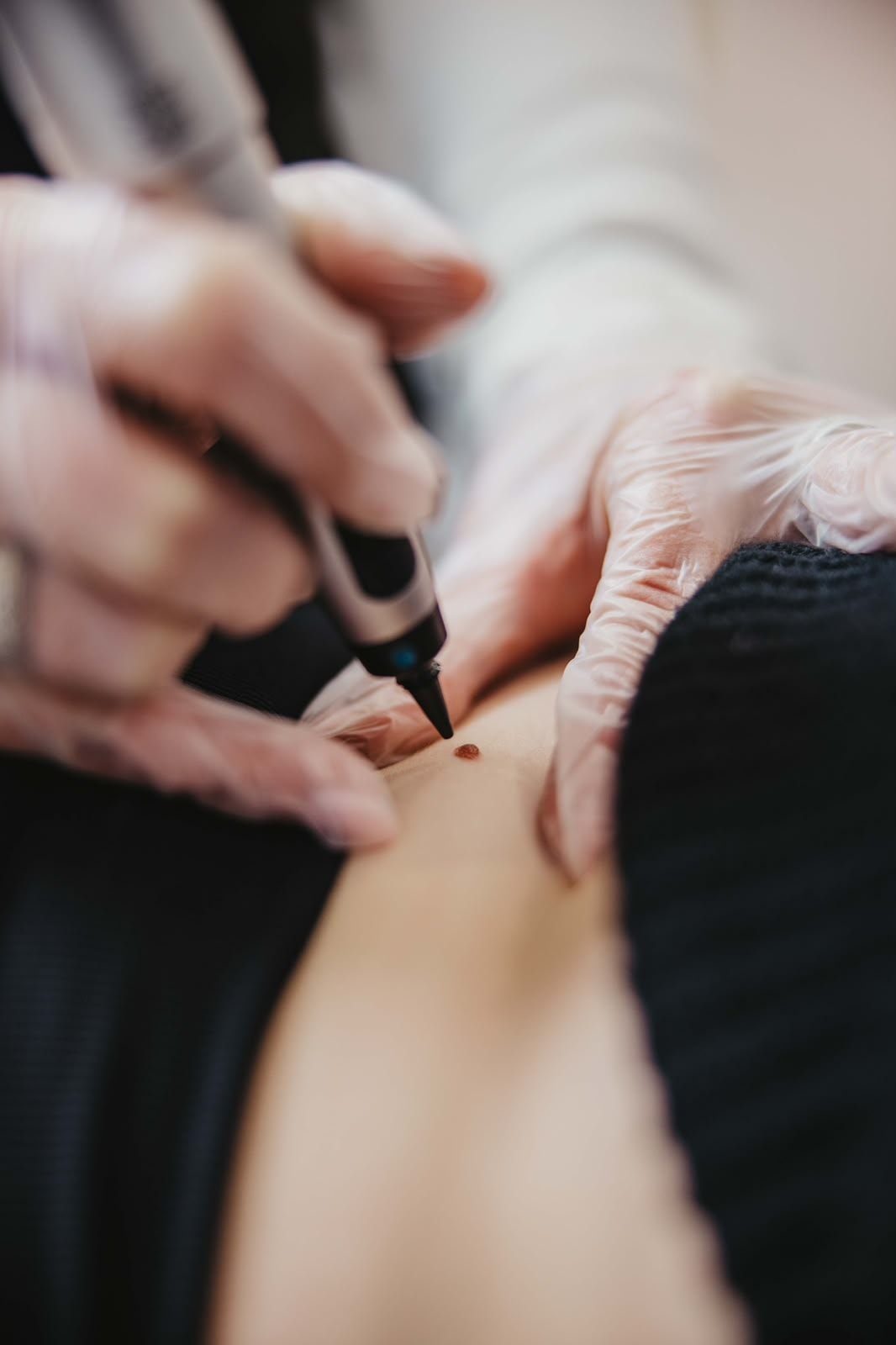 CryoPen treatment