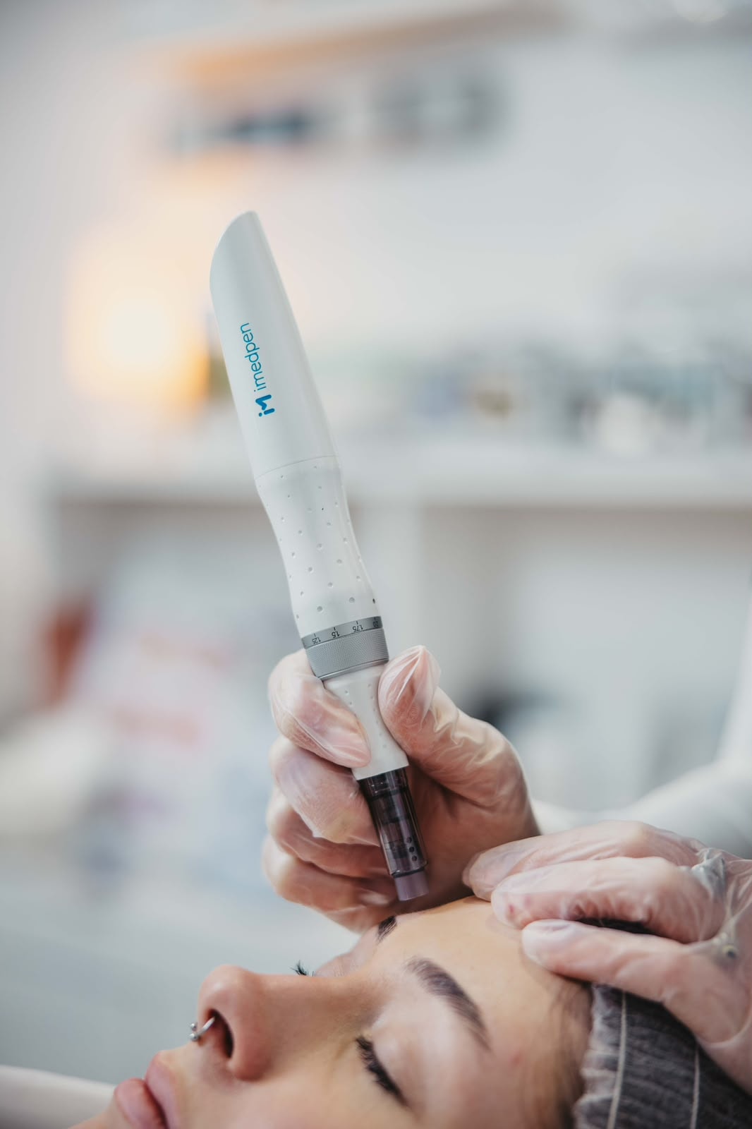 Microneedling treatment